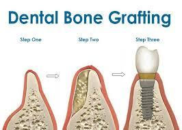 Bone-graft